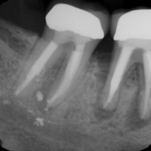 RCT failure