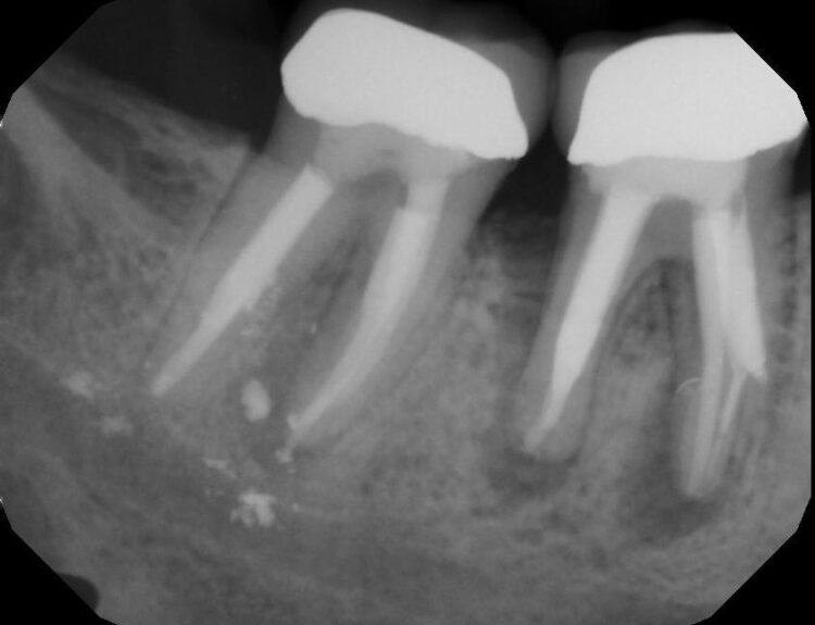 RCT failure