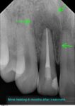  Root Canal Retreatment
