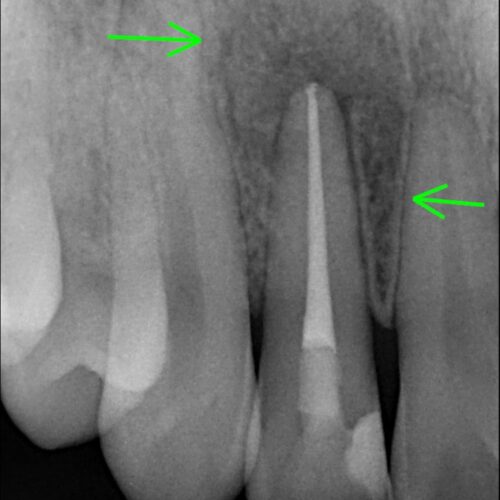 root Canal Retretment