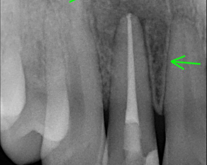 root Canal Retretment