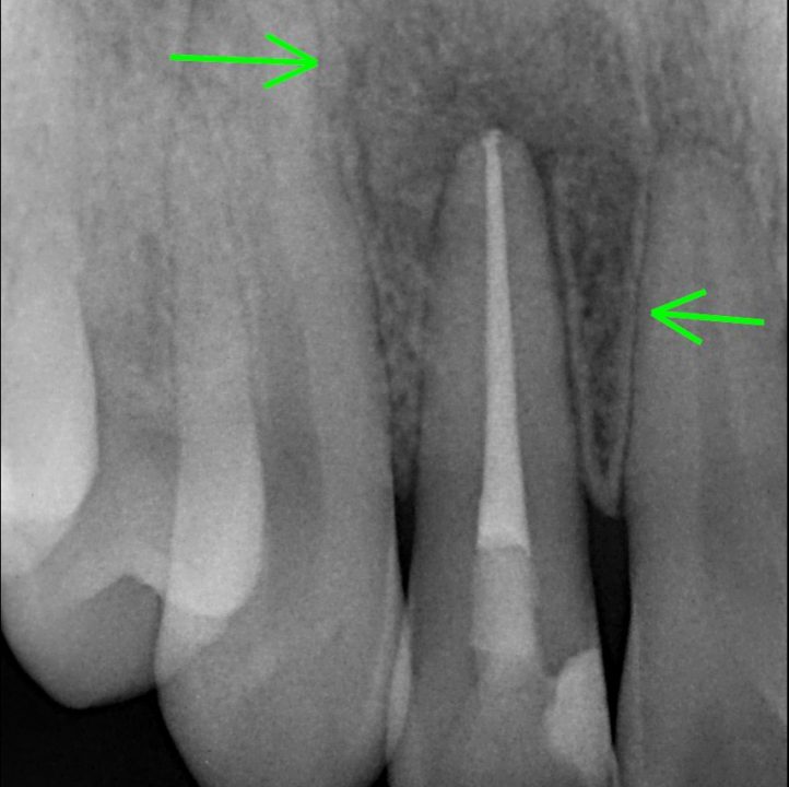 root Canal Retretment