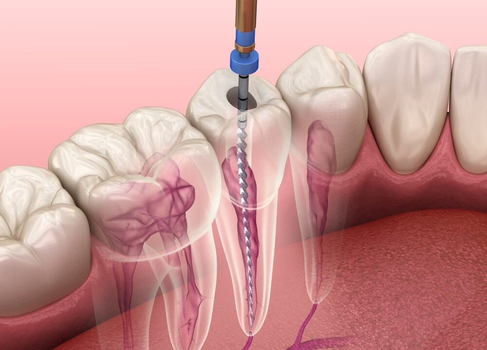 Root Canal Treatment