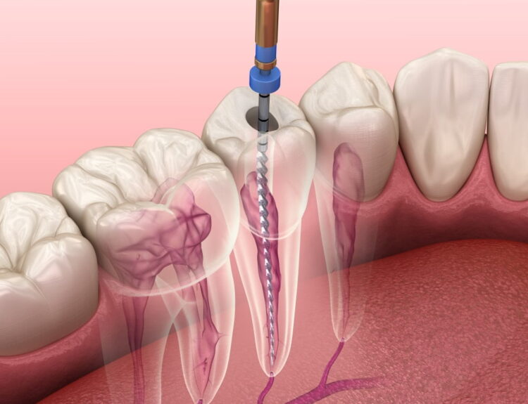 Root Canal Treatment