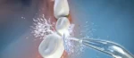 Water Flossers: An effective complement to traditional floss