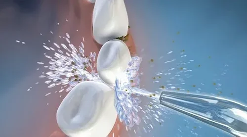 water flosser