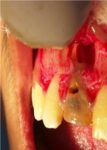 Apicoectomy: A Surgical Approach to RCT Failure