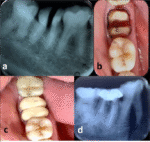 Bicuspidization in Dental Practice