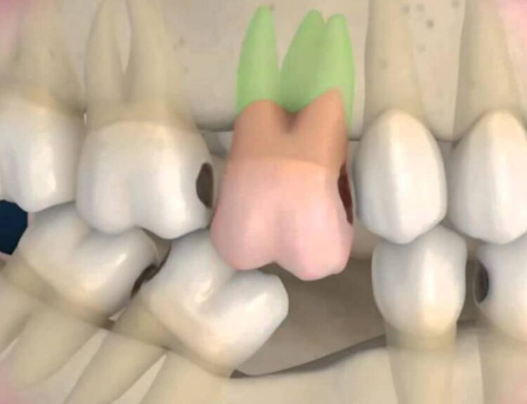 effect of tooth loss