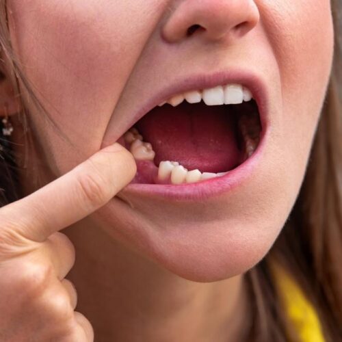 immature adult tooth loss