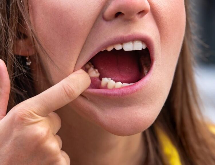 immature adult tooth loss