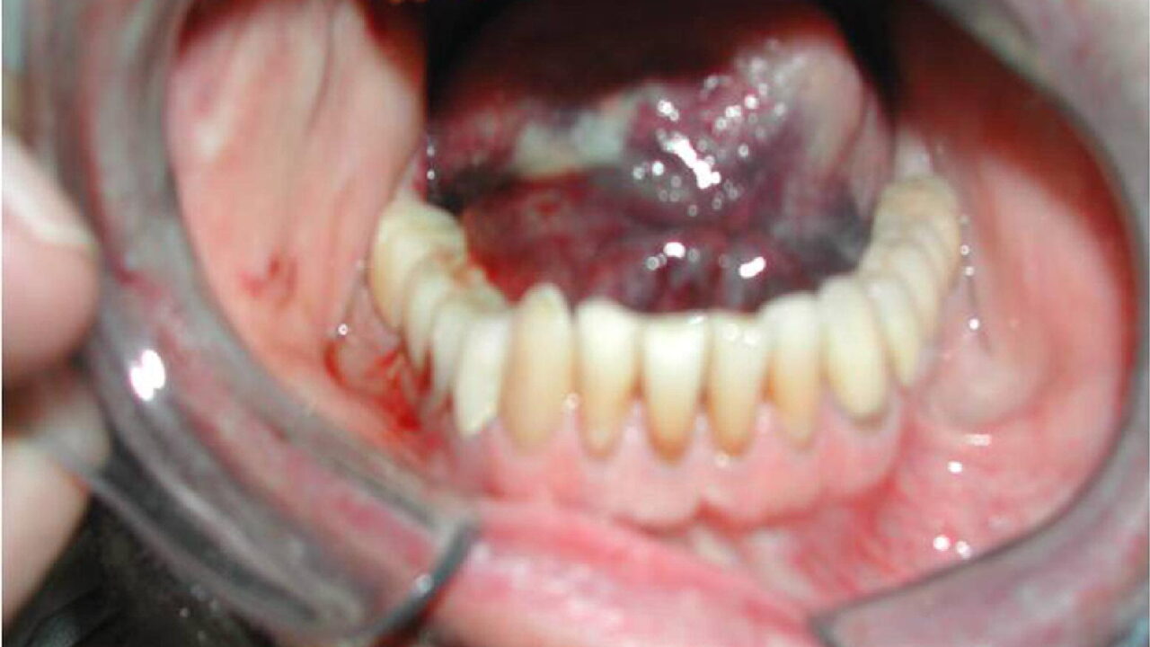 Oral Hematoma