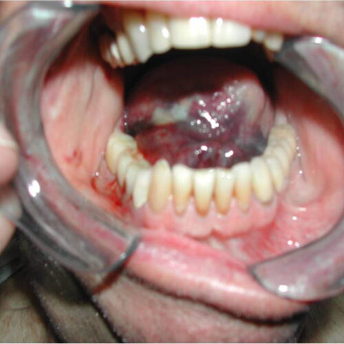 Oral Hematoma