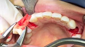 Premolar Extraction