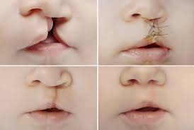 Cleft lip & Palate