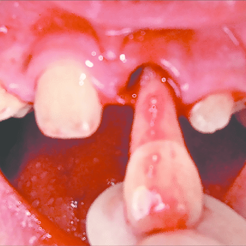knocked out permanent tooth