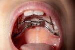 Jaw Expander – What Parents Should Know