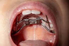 Jaw Expander