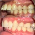 Retrognathia: An Abnormal Jaw Positioning
