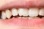 Chipped Tooth:  Can It Heal on Its Own?