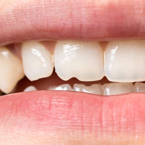 chipped tooth