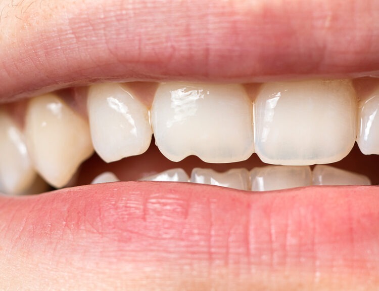 chipped tooth