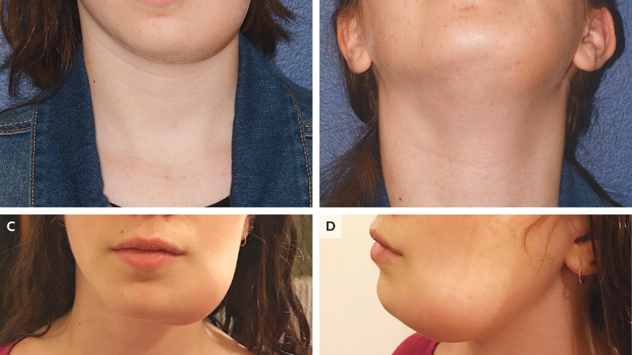 Hypercalcemia: How Excess Calcium Affects Oral Health