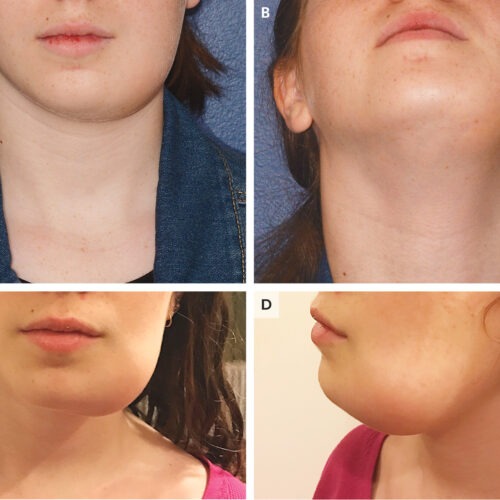Jaw hyperclacemia