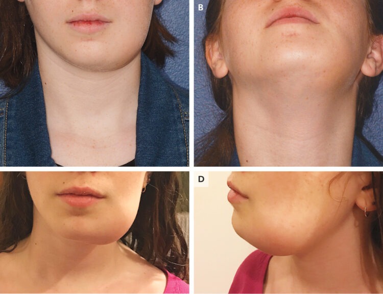 Jaw hyperclacemia