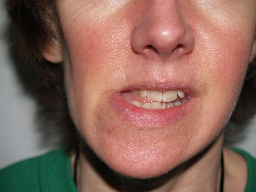 Oro-Mandibular Dystonia – A neurological disorder of lower face