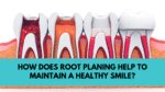 Root Planing: A Teeth Cleaning Procedure that Saves Your Smile