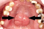 Torus Palatinus: A Bony Lump on the Roof of the Mouth