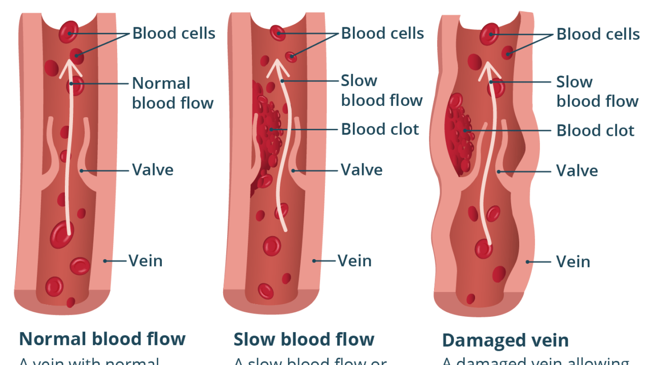thrombosis
