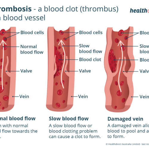 thrombosis