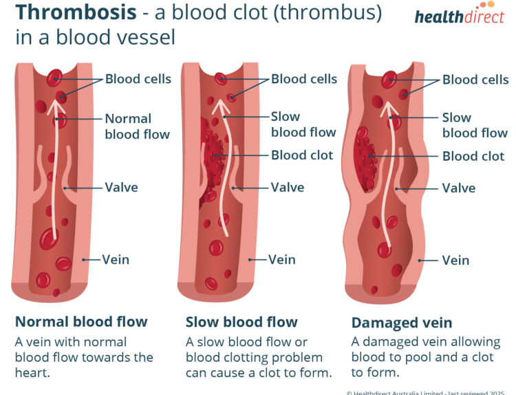 thrombosis