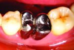 Bicuspidization: Saving Compromised Molars Through Conservative Dentistry