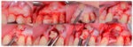 Odontoma: A Benign Dental Tumor